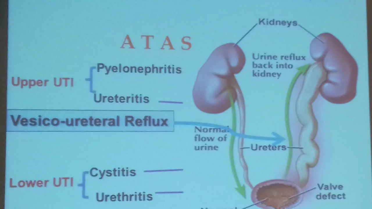 The Connection Between Urinary Tract Infections and Kidney Stones