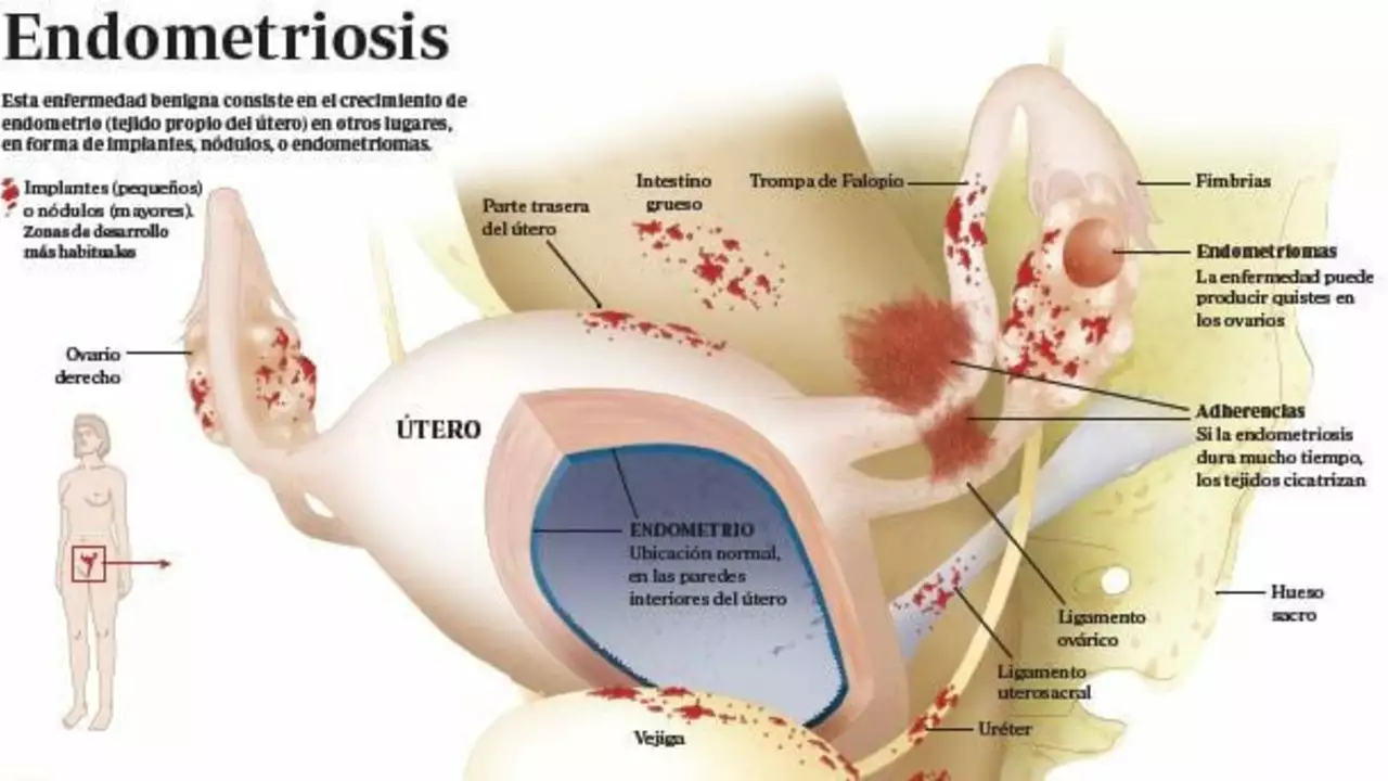 Can Letrozole Help Treat Endometriosis?